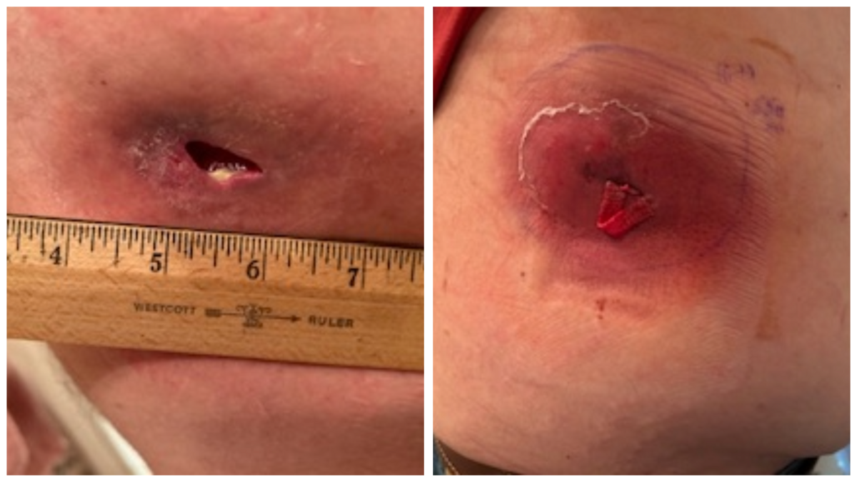 Photos show the size of Scott Tighe’s abdomen wound from a post-surgical infection, left, and the wound packed with gauze. Tighe had a bile leak and sepsis after a gallbladder removal surgery at Saint Alphonsus in Nampa in October 2022.